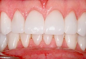 Zen Dentistry | Teeth Whitening, ZOOM  Whitening and Porcelain Veneers